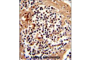 Formalin-fixed and paraffin-embedded human kidney carcinoma reacted with SERPINB7 Antibody , which was peroxidase-conjugated to the secondary antibody, followed by DAB staining. (SERPINB7 抗体  (AA 108-137))