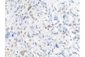 Phospho-KDM3A (Tyr1114) Antibody at 1/100 staining Human ovarian cancer by IHC-P. (KDM3A 抗体  (pTyr1114))