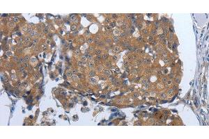 Immunohistochemistry of paraffin-embedded Human breast cancer tissue using PDIA2 Polyclonal Antibody at dilution 1:50 (PDIA2 抗体)
