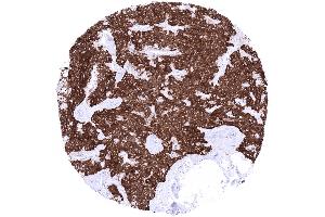 Thyroid Medullary carcinoma with strong cytoplasmic synaptophysin immunostaining of all tumor cells (Recombinant Synaptophysin 抗体  (AA 274-313))