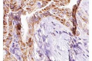 ABIN6267637 at 1/100 staining human Thyroid cancer tissue sections by IHC-P. (BIK 抗体  (pThr33))