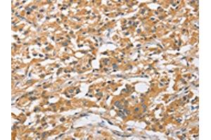 The image on the left is immunohistochemistry of paraffin-embedded Human thyroid cancer tissue using ABIN7128517(ARL8A Antibody) at dilution 1/20, on the right is treated with fusion protein. (ARL8A 抗体)