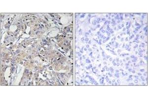 Immunohistochemistry analysis of paraffin-embedded human breast carcinoma tissue, using Collagen VI alpha3 Antibody. (COL6a3 抗体  (AA 2261-2310))