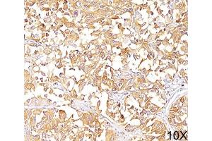 IHC staining of human melanoma (10X) with gp100 antibody (HMB45). (Melanoma gp100 抗体)