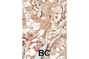 Formalin-fixed and paraffin-embedded human cancer tissue reacted with PDGFRB polyclonal antibody  , which was peroxidase-conjugated to the secondary antibody, followed by AEC staining. (PDGFRB 抗体  (N-Term))