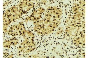 ABIN6276504 at 1/100 staining Human breast cancer tissue by IHC-P. (MAGED1 抗体  (Internal Region))