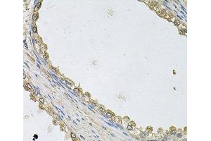 Immunohistochemistry of paraffin-embedded Human prostate using MTERFD1 Polyclonal Antibody at dilution of 1:100 (40x lens). (MTERFD1 抗体)