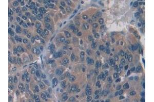 Detection of IL12A in Human Liver cancer Tissue using Monoclonal Antibody to Interleukin 12A (IL12A) (IL12A 抗体  (AA 23-219))