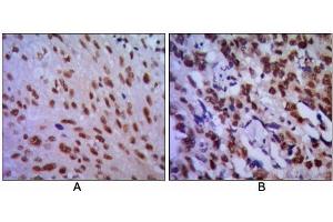 Immunohistochemical analysis of paraffin-embedded human lung cancer (A) and esophageal cancer (B), showing cytoplasmic localization using CDC2 antibody with DAB staining. (CDK1 抗体)