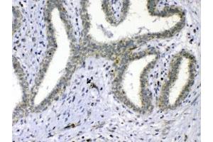 IHC testing of FFPE human breast cancer tissue with Cdc20 antibody at 1ug/ml.