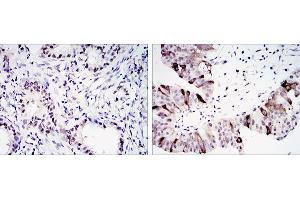 Immunohistochemical analysis of paraffin-embedded lung cancer (left) and ovary tumour tissues (right) using CCNB1 mouse mAb with DAB staining. (Cyclin B1 抗体)