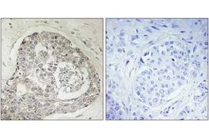 Immunohistochemistry analysis of paraffin-embedded human breast carcinoma, using K0100 Antibody. (KIAA0100/BCOX1 抗体  (AA 681-730))