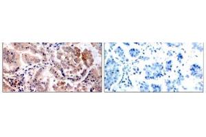 Immunohistochemical analysis of paraffin-embedded human lung carcinoma tissue, using AMPK1 (Ab-174) antibody (E021191). (PRKAA1 抗体)