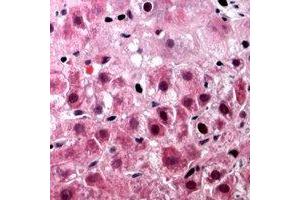 Immunohistochemical analysis of TUFM staining in human liver cancer formalin fixed paraffin embedded tissue section. (TUFM 抗体)