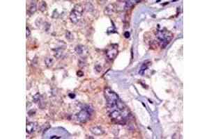 IHC analysis of FFPE human breast carcinoma tissue stained with the LCK antibody (LCK 抗体  (AA 23-52))