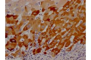 IHC image of ABIN7127603 diluted at 1:100 and staining in paraffin-embedded human liver cancer performed on a Leica BondTM system. (Recombinant LRG1 抗体)