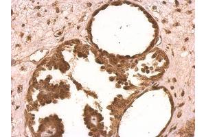 IHC-P Image XLF antibody [N3C3] detects XLF protein on human ovarian carcinoma by immunohistochemical analysis. (NHEJ1 抗体)