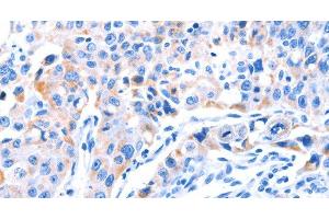 Immunohistochemistry of paraffin-embedded Human lung cancer tissue using SMG8 Polyclonal Antibody at dilution 1:50 (SMG8 抗体)