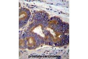 Formalin fixed, paraffin embedded human prostate carcinoma stained with YI016 Antibody (C-term) followed by peroxidase conjugation of the secondary antibody and DAB staining. (YI016 (AA 260-288), (C-Term) 抗体)