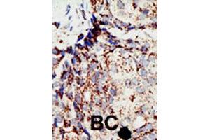Formalin-fixed and paraffin-embedded human cancer tissue reacted with BAP1 polyclonal antibody  , which was peroxidase-conjugated to the secondary antibody, followed by DAB staining. (BAP1 抗体  (N-Term))