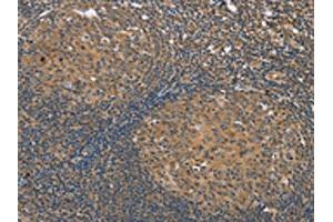 The image on the left is immunohistochemistry of paraffin-embedded Human tonsil tissue using ABIN7191184(KCNJ15 Antibody) at dilution 1/35, on the right is treated with synthetic peptide. (KCNJ15 抗体)