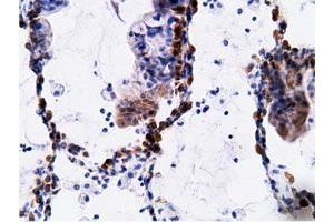 Immunohistochemical staining of paraffin-embedded Adenocarcinoma of Human breast tissue using anti-EPHX2 mouse monoclonal antibody. (EPHX2 抗体)