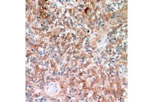 Immunohistochemical analysis of TRP2 staining in human breast cancer formalin fixed paraffin embedded tissue section. (DCT 抗体)