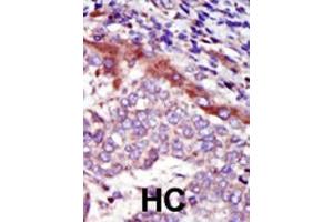 Formalin-fixed and paraffin-embedded human cancer tissue reacted with the primary antibody, which was peroxidase-conjugated to the secondary antibody, followed by AEC staining. (HUNK 抗体  (C-Term))