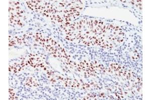 Formalin-fixed, paraffin-embedded human bladder carcinoma stained with p57 antibody (57P06). (CDKN1C 抗体)