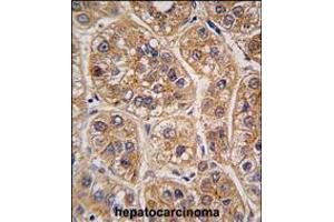 Formalin-fixed and paraffin-embedded human hepatocarcinoma tissue reacted with AKR1A1 antibody , which was peroxidase-conjugated to the secondary antibody, followed by DAB staining. (AKR1A1 抗体  (C-Term))