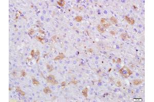 Paraformaldehyde-fixed, paraffin embedded human hepatocellular carcinoma, Antigen retrieval by boiling in sodium citrate buffer (pH6) for 15min, Block endogenous peroxidase by 3% hydrogen peroxide for 30 minutes, Blocking buffer (normal goat serum) at 37°C for 20min, Antibody incubation with Serum albumin (3F4) Monoclonal Antibody, Unconjugated (bsm-0945M) at 1:500 overnight at 4°C, followed by a conjugated secondary and DAB staining. (Albumin 抗体)