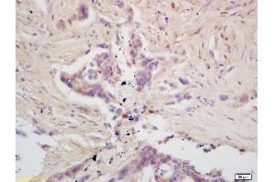 Formalin-fixed and paraffin embedded human colon carcinoma labeled with Rabbit Anti GPAM Polyclonal Antibody, Unconjugated (ABIN709121) at 1:200 followed by conjugation to the secondary antibody and DAB staining (GPAM 抗体  (AA 611-710))