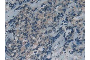 DAB staining on IHC-P; Samples: Human Thyroid cancer Tissue (GAS6 抗体  (AA 136-311))