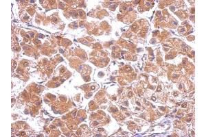 IHC-P Image Immunohistochemical analysis of paraffin-embedded human hepatoma, using CACNB4, antibody at 1:500 dilution. (CACNB4 抗体  (C-Term))