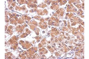 IHC-P Image Immunohistochemical analysis of paraffin-embedded human hepatoma, using CACNB4, antibody at 1:500 dilution.