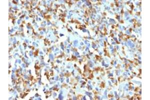 Immunohistochemical staining (Formalin-fixed paraffin-embedded sections) of human histiocytoma with F13A1 monoclonal antibody, clone F13A1/1683 . (F13A1 抗体  (AA 46-181))