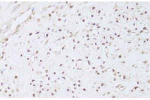 Immunohistochemistry of paraffin-embedded Human leiomyoma of uterus using FKBP4 Polyclonal Antibody at dilution of 1:100 (40x lens).
