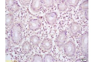 Formalin-fixed and paraffin embedded human gastric carcinoma labeled with Rabbit Anti BCL-6/5 Polyclonal Antibody, Unconjugated  at 1:200 followed by conjugation to the secondary antibody and DAB staining (BCL6 抗体  (AA 501-600))