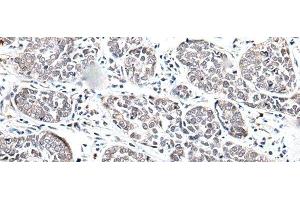 Immunohistochemistry of paraffin-embedded Human esophagus cancer tissue using BRMS1L Polyclonal Antibody at dilution of 1:45(x200) (BRMS1L 抗体)