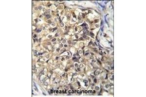 KLHL35 Antibody (C-term) (ABIN656072 and ABIN2845420) immunohistochemistry analysis in formalin fixed and paraffin embedded human breast carcinoma followed by peroxidase conjugation of the secondary antibody and DAB staining. (KLHL35 抗体  (C-Term))