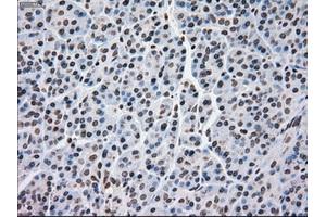 Immunohistochemical staining of paraffin-embedded Adenocarcinoma of breast tissue using anti-MRI1 mouse monoclonal antibody. (MRI1 抗体)