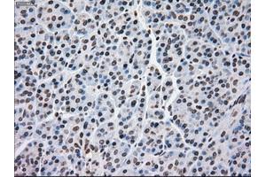 Immunohistochemical staining of paraffin-embedded Adenocarcinoma of breast tissue using anti-MRI1 mouse monoclonal antibody.