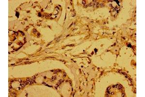 Immunohistochemistry of paraffin-embedded human pancreatic cancer using ABIN7168921 at dilution of 1:100 (HTRA2 抗体  (AA 334-458))
