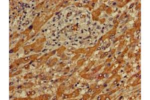 Immunohistochemistry of paraffin-embedded human liver cancer using ABIN7166683 at dilution of 1:100 (APOBEC4 抗体  (AA 221-367))