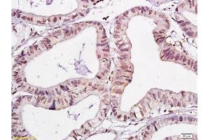 Formalin-fixed and paraffin embedded human gastric carcinoma labeled with Anti-WWOX Polyclonal Antibody , Unconjugated at 1:200, followed by conjugation to the secondary antibody and DAB staining (WWOX 抗体  (AA 5-100))