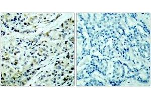 Immunohistochemistry analysis of paraffin-embedded human breast carcinoma, using HDAC5 (Phospho-Ser498) Antibody.