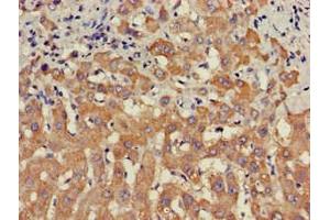 Immunohistochemistry of paraffin-embedded human liver cancer using ABIN7169681 at dilution of 1:100 (STAT4 抗体  (AA 569-748))