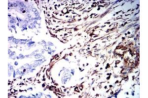 Immunohistochemical analysis of paraffin-embedded rectum cancer tissues using VIM mouse mAb with DAB staining. (Vimentin 抗体  (AA 2-466))