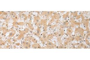 Immunohistochemistry of paraffin-embedded Human liver cancer tissue using DHRSX Polyclonal Antibody at dilution of 1:30(x200) (DHRSX 抗体)