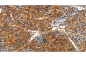 Immunohistochemistry of paraffin-embedded Human liver cancer using VWA5A Polyclonal Antibody at dilution of 1:60 (VWA5A 抗体)